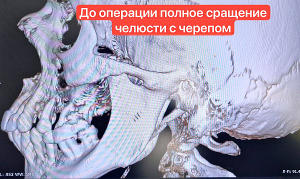 Чаллы табиблары уникаль операция ясады